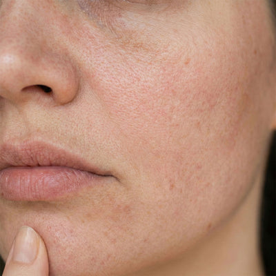 Dull and tired skin