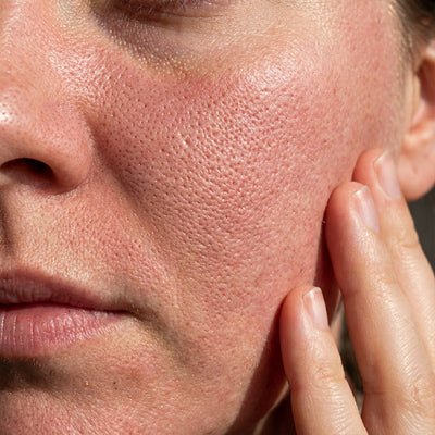 Enlarged Pores